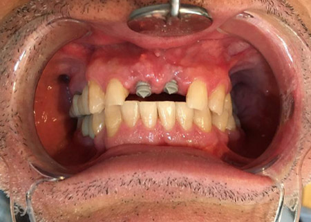 implant_01
