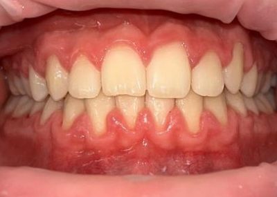 Logan Kilian Close Up After Ortho