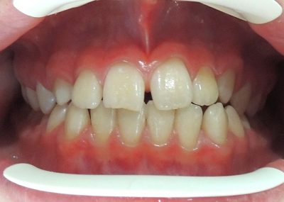 Logan Kilian Close Up Before Ortho