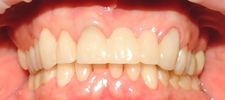 dentures_after