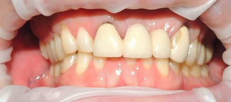 dentures_before