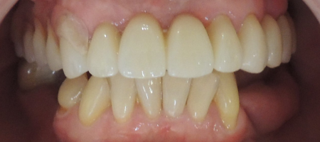 dentures_case1_before